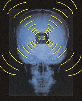 Radografia Ondas Cerebro